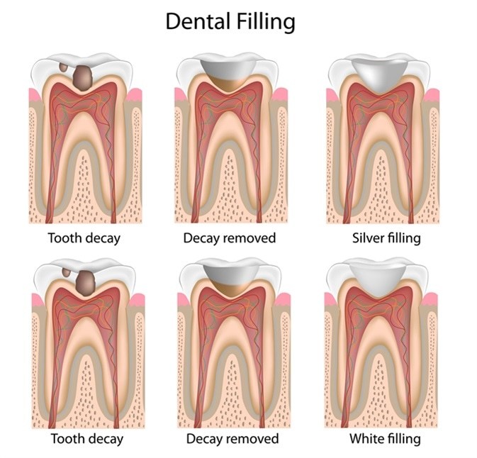 Procudre for Dental Filling at our Box Hill Dental Clinic