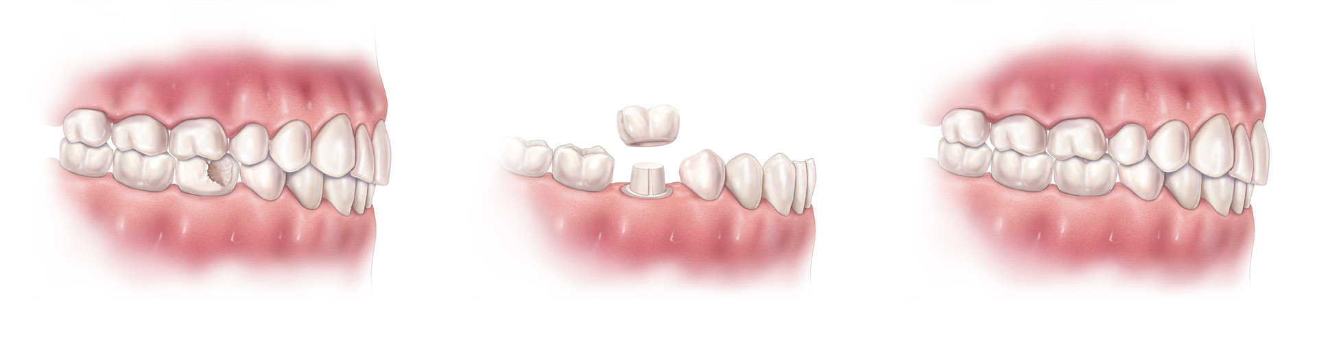 Procedure to prepare and fit dental crowns