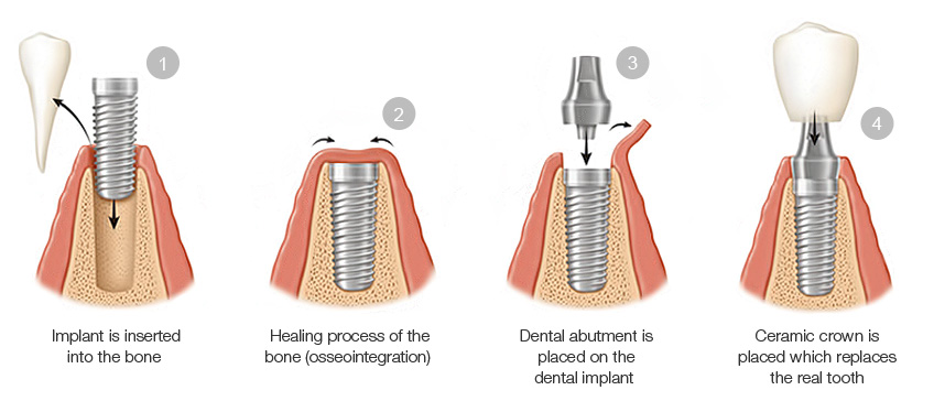 The procedure of a dental implant at our Box Hill Dental Clinic