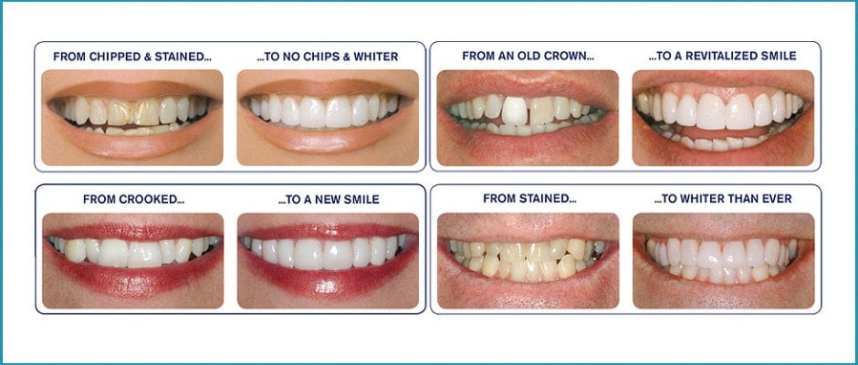 box-hill-veneers-veneers-prices-and-photos-open-6-days