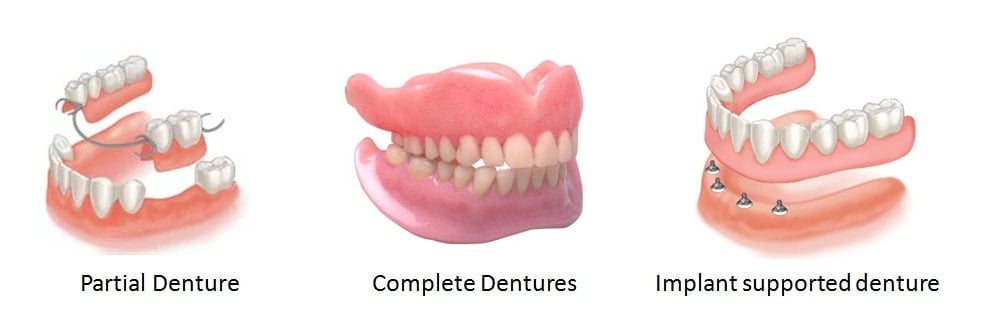 Different types of dentures which can be used at our Box Hill Dental Clinic