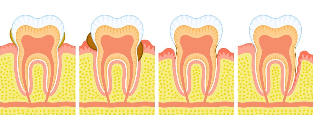 Different types of Gum Disesease