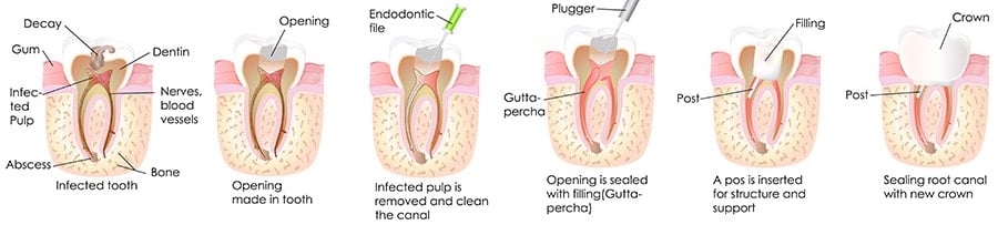 Procudre for Root Canal at our Box Hill Dental Clinic