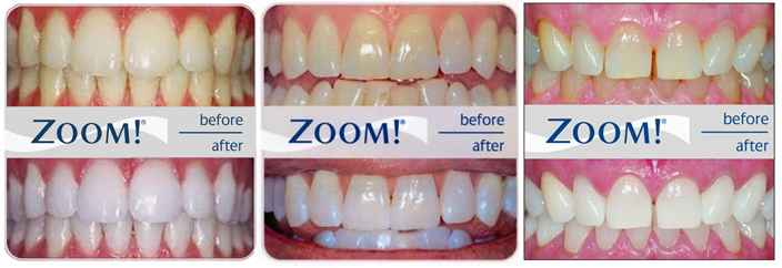 Teeth Whitening results from our Box Hill Dentist