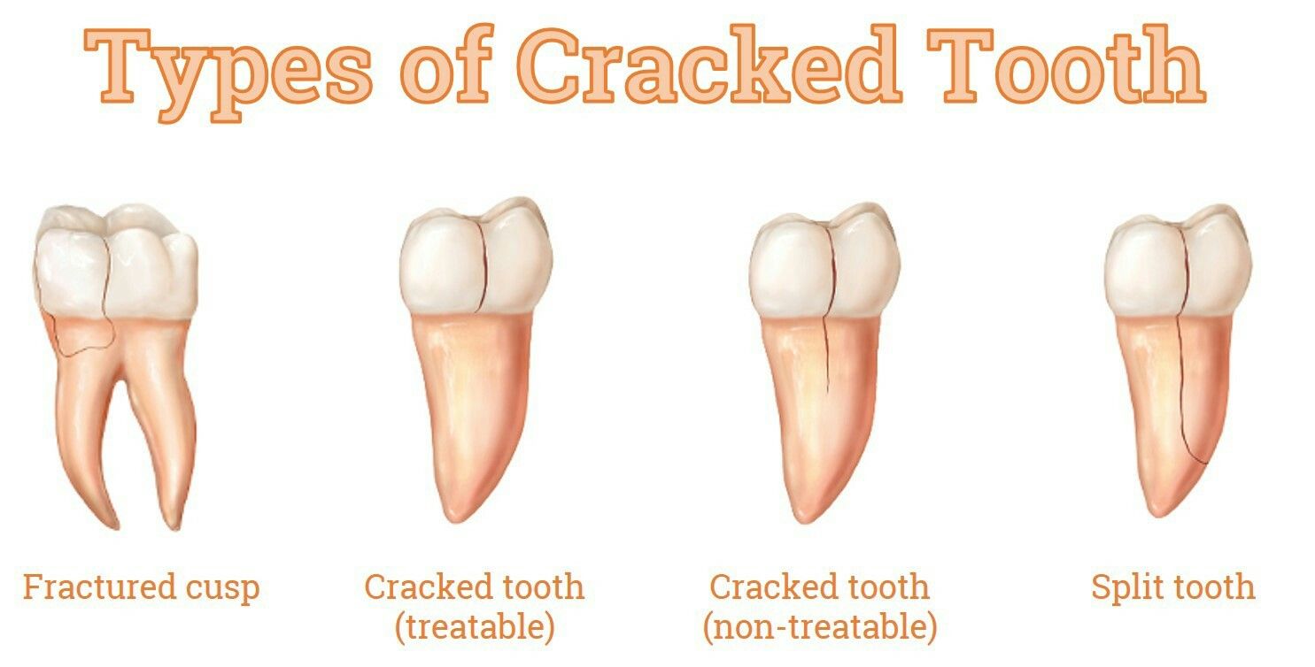 cracked molar