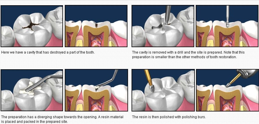 Step by Step Dental Filling Procedure