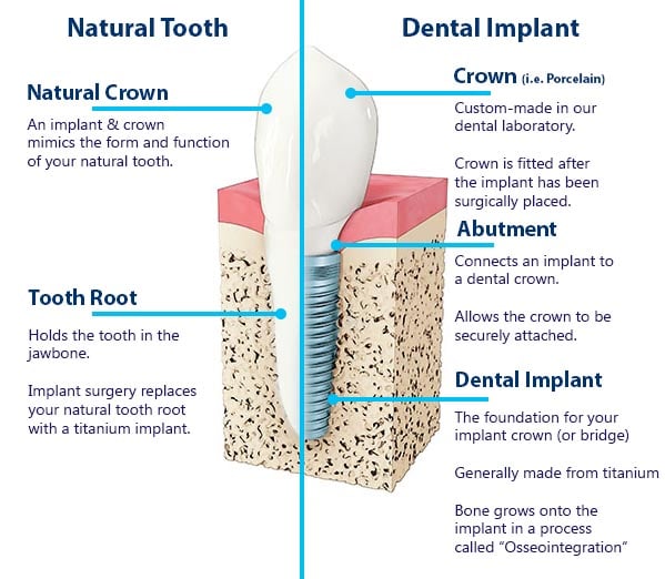 Dental Implant Guide On Dental Implants Cost Procedure Photos