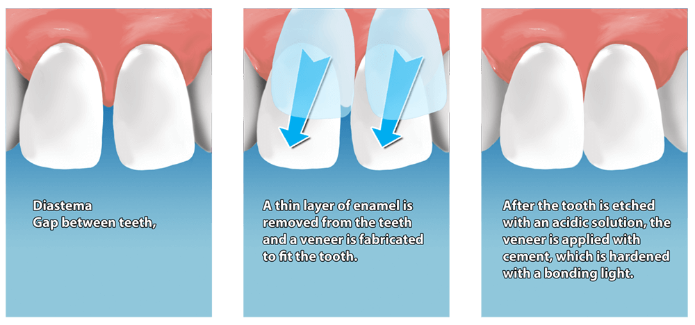 veneers dental veneer tooth bonding teeth process dentistry procedure cosmetic guide columbia advantages riddle between february