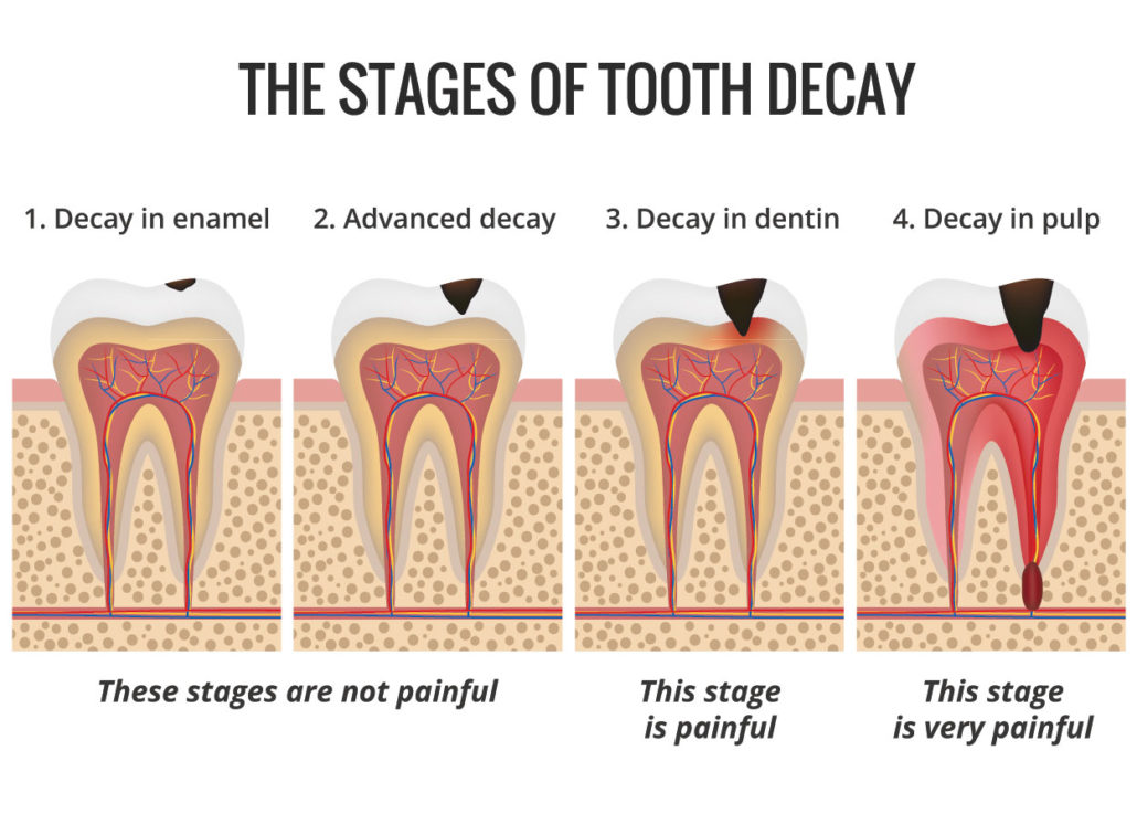 Cavity in deals molar teeth