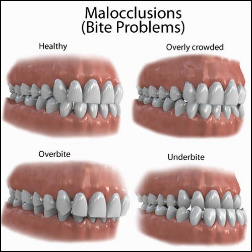 Comparing uneven bite in patients.